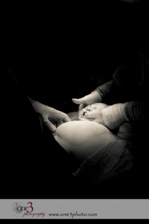 c-section birth picture
